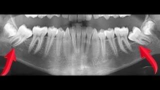 🔥Unexpected orthodontic impactions of mandibular second molars🔥