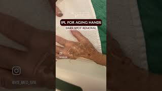 IPL for aging hands, rejuvenation treatment to remove dark spots, pigmentation and wrinkles