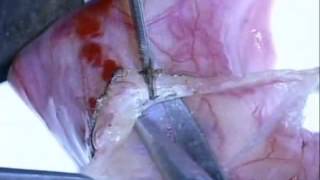 Varicocelectomy: Microscopic subinguinal (Marmar) technique