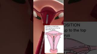 Copper IUD insertion. #shorts #familyplanning #health #ytshorts #education #tips