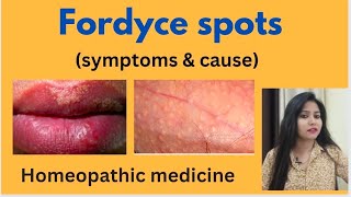 Fordyce spots treatment !! Fordyce spots symptoms,causes & homeopathic medicine in hindi