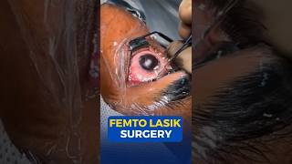 Femto Lasik Surgery