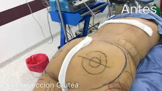 Aumento de Gluteos Medellin Colombia