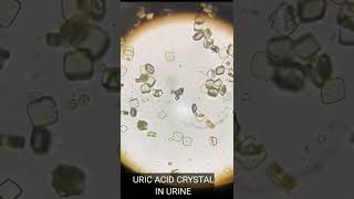 Uric acid crystal present in urine | Urine examination | Urine microscopic examination