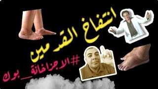 #تورم القدمين الاسباب والعلاج _انتفاخ القدمين والساق #تورم القدمين في الحمل والفرق بين التورم