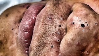 Acne Compilation