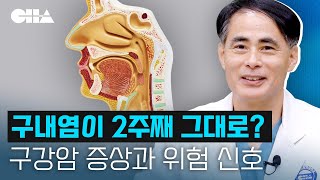 구내염이 2주째 계속된다? 구강암의 증상과 위험신호