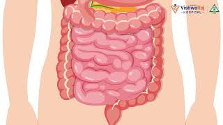 Stomach Diseases | VishwaRaj Hospital - Best Multispecialty Hospital in Pune