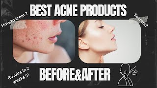 Best Acne Fighting Products | Dermatologist at the Drugstore