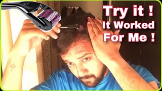 My Hair Regrowth after leaving Finasteride Part 1 Microneedling / Derma Roller Hair Loss Update