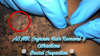 Ingrown Hair Removal & Extractions Pt 10 🔍| Neck & Beard Area| ASMR, Slight Talking