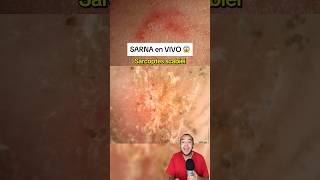 Ácaro de SARNA captado EN VIVO 😱 #shorts #medicina #salud