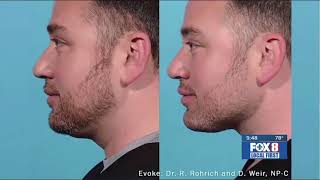 Ditch the Double Chin & Jowls with Evoke