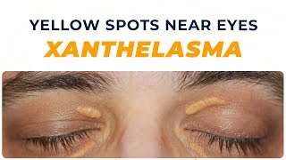 What is Xanthelasma? | Where can it happen? | Why it happens? | Different treatment methods!