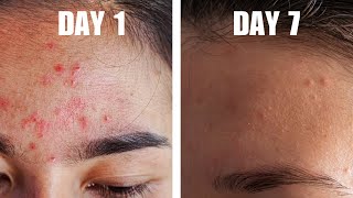 REMOVE ACNE, Pimples and Blackheads and get Clear Skin in 1 Week.😀