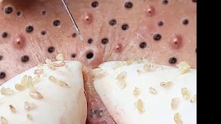 Blackhead Removal - How to Remove Blackheads Easily like a Pro