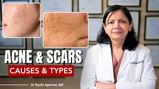 Acne & Scars Causes & Treatments | How to treat acne | Dr Ruchi Agarwal  #acnescarstreatment #satya