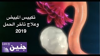 أخر تطورات علاج تكييس المبيض المسبب لتأخر الحمل 2019؟