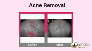 Acne Removal - Case 1 - Dr Mohan Skin & Hair Clinic