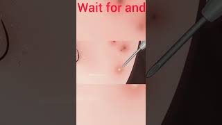 Satisfying Relaxation Blackhead Removal, Blackhead extraction#trending#shorts#short#viralvideos#asmr