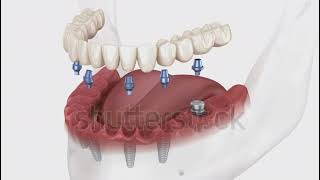 Implantologia All on 4 #implantologia #implantdentistry #implantology #implantsurgery #allon4