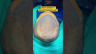 Hair Loss Treatment #hair #hairloss #hairlosstreatment #ytshorts #alopecia #hairtransplant #hairfall