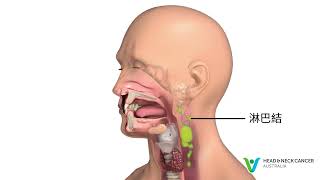 Cantonese/ Traditional Chinese - What is Hypopharyngeal & Laryngeal Cancer? Symptoms & Treatment?