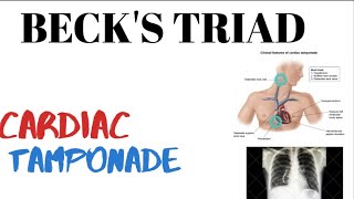 Becks triad | Cardiac tamponade | Pericardial effusion | medinject