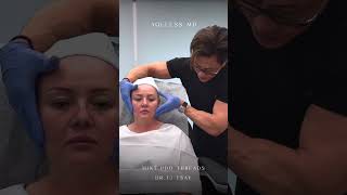 MINT PDO Threads - Nonsurgical Facelift