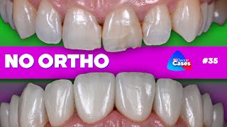 No ortho | BG Dental Cases #35