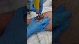 Quanta Laser Tattoo Removal Training.