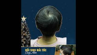 #Short Rụng tóc trọc đầu vẫn mọc lại được,  nếu dùng đúng phương pháp