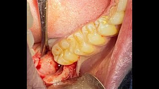 surgical removal of distoangular impacted wisdom using purchase point technique .