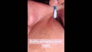 Botfly Extraction From Eye #oddlysatisfying #sick #blackhead #pimplepopper #satisfying #cyst #omg