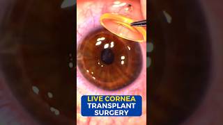 Cornea Transplant LIVE Surgery