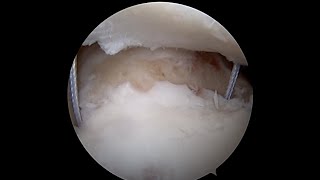 Arthroscopic Remplissage Technique