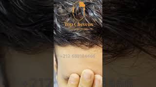 تركيب مقدة الرأس شعر طبيعي 💯 فقط عند top cheveux 0688164466 #الباروكة_رجال #الباروكة #الشعر_المستعار