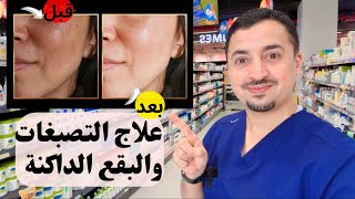 علاج التصبغات والبقع الداكنة (كلف ،نمش ،آثار) بأفضل سيروم تفتيح للوجه ✨