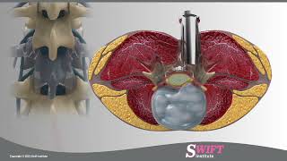 Lumbar Microdiscectomy in Reno, Sparks, Carson City at Swift Institute