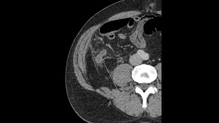 Appendicitis - CT findings. Familiarise yourself with the appearances.