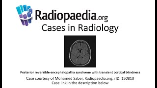 PRES with transient cortical blindness (Radiopaedia.org) Cases in Radiology