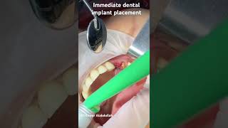 Immediate dental implant placement #dranwar #oralandmaxillofacialsurgery #dentistry