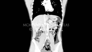 Coronal CT Arterial Series Anteroposterior