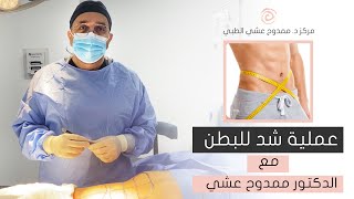 عملية شد للبطن مع الدكتور ممدوح عشي