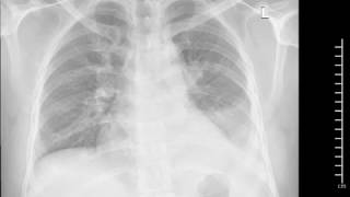 Mild or moderate effusion? Ultrasound to rescue.