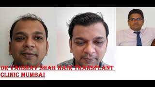 Amazing results of Hair Transplant in Mumbai