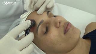 Microagulhamento facial