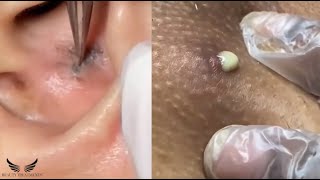 Ear Blackhead Whitehead Removal - Hidden Cystic Acne Treatment - Elderly Acne Spa Relaxing | #143