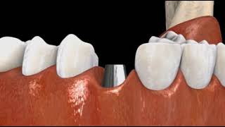 Implant: Metal, CAD/CAM Crown