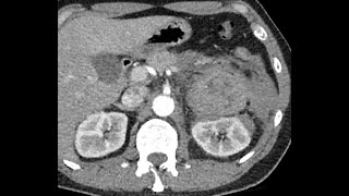 Pheochromocytoma bleeding - Life Threatening condition !!! Beware !!!